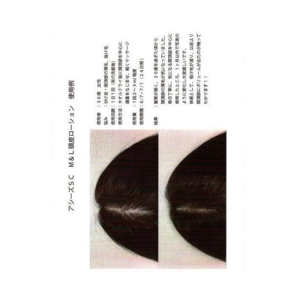 画像6: アシーズSC M&L(Man & Lady)頭皮ローション　ヒト毛根細胞順化培養液配合76ｍL (6)